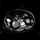 Renal cell carcinoma, atypical: CT - Computed tomography
